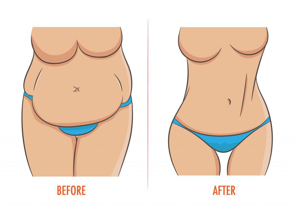 Mommy makeover