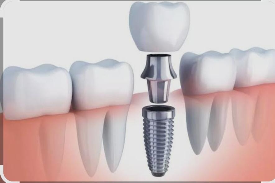 Dental Implant